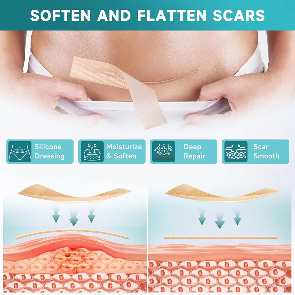Silicone Scar Sheets