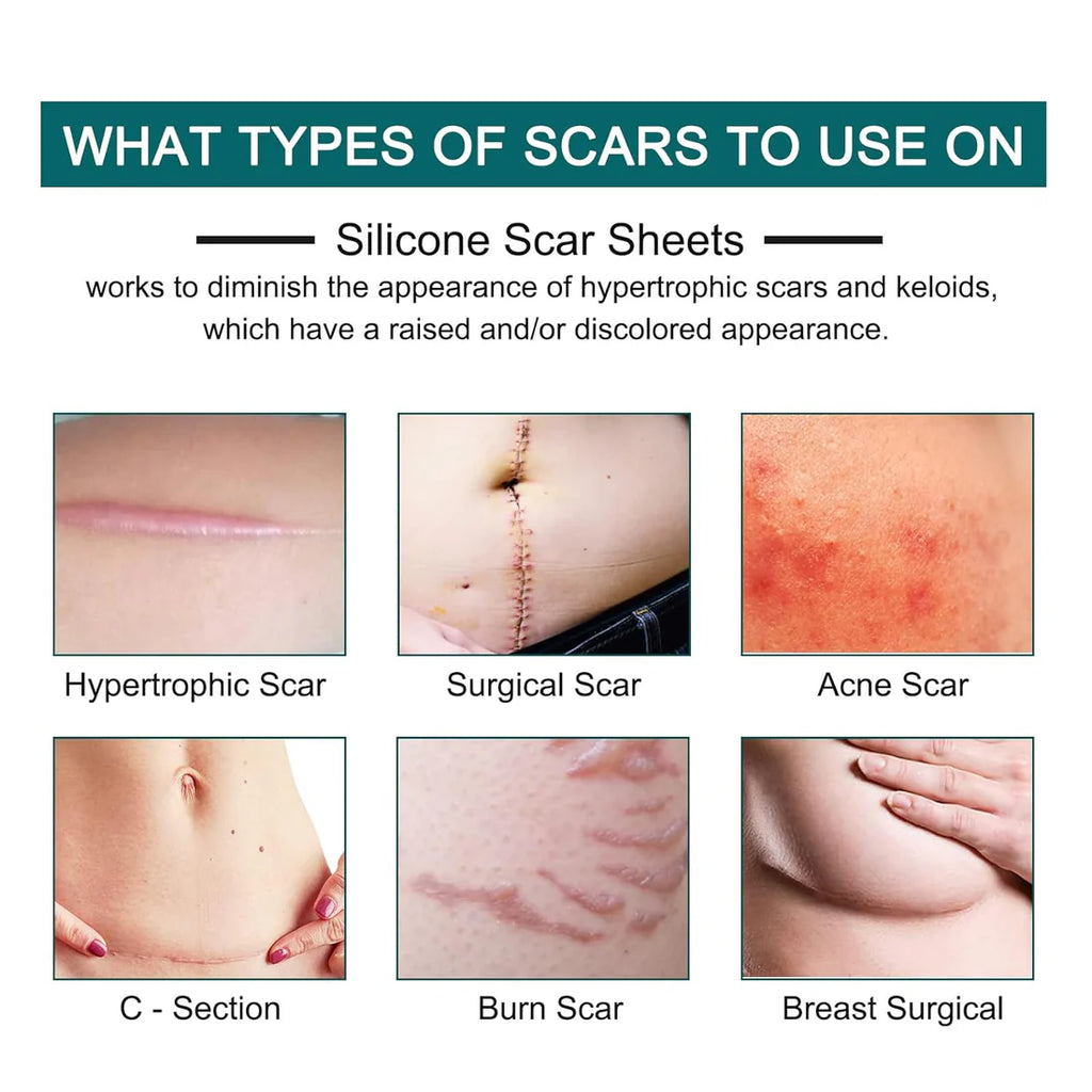 Silicone Scar Sheets