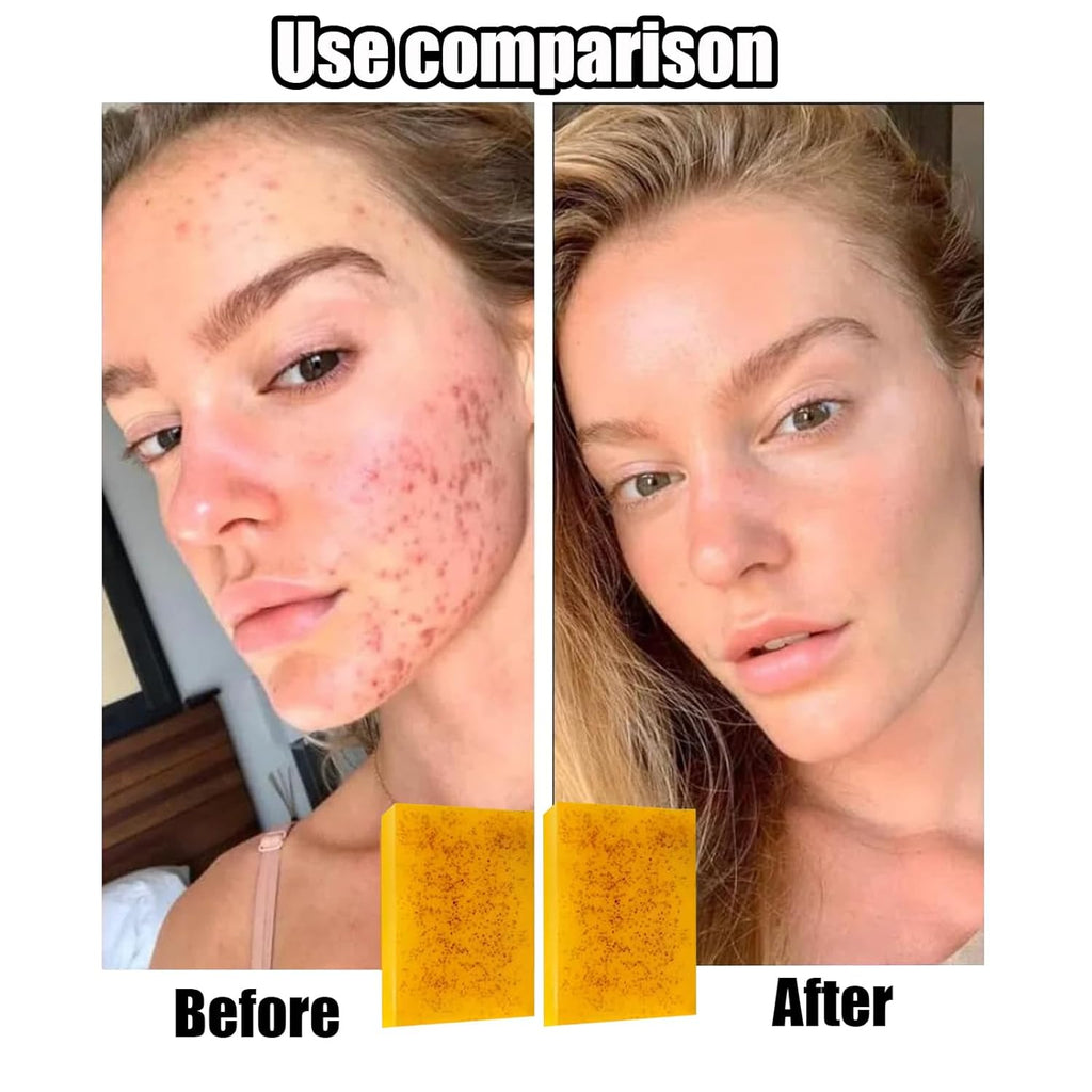 Turmeric & Kojic Acid - Brightening Soap