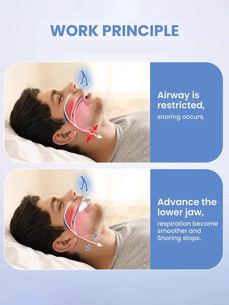 ZQuiet™ Anti Snore Mouthpiece